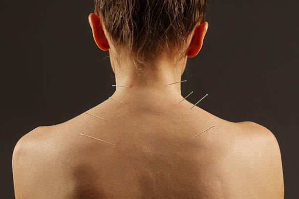 Needle Little Help About Dry Needling? 1 needles